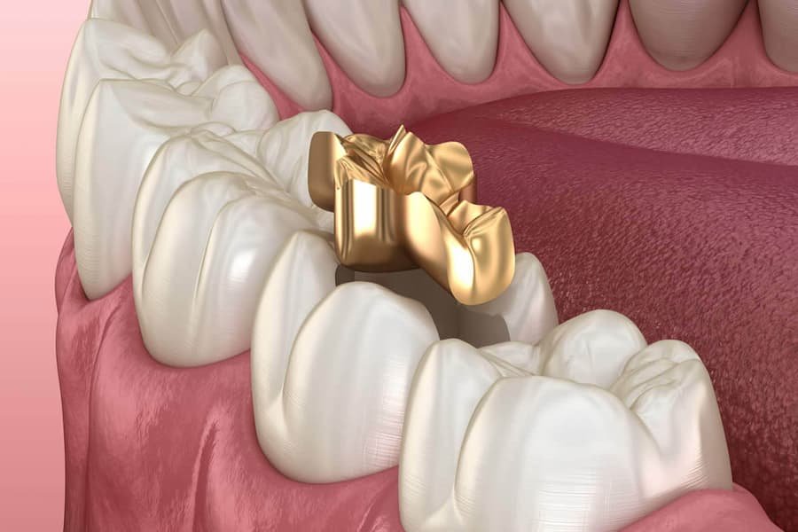 Gold Dental Crowns